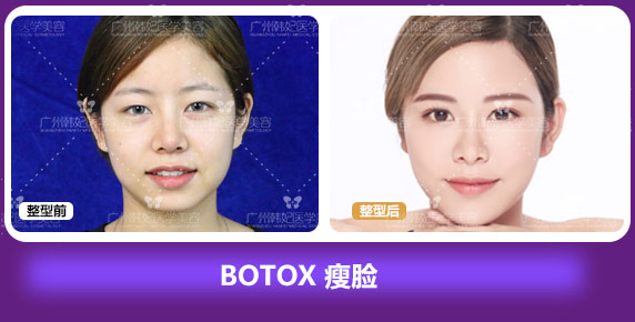 BOTOX 瘦脸