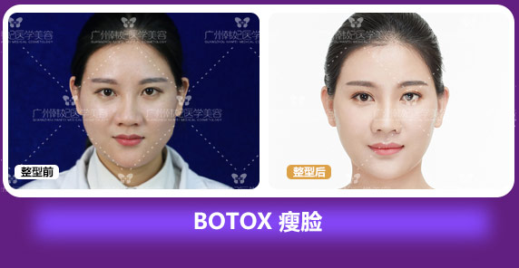 BOTOX 瘦脸