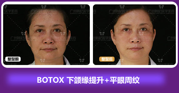 BOTOX下颌缘提升+平眼周纹