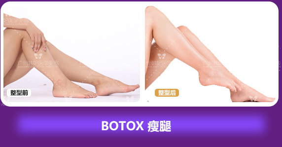 BOTOX 瘦腿